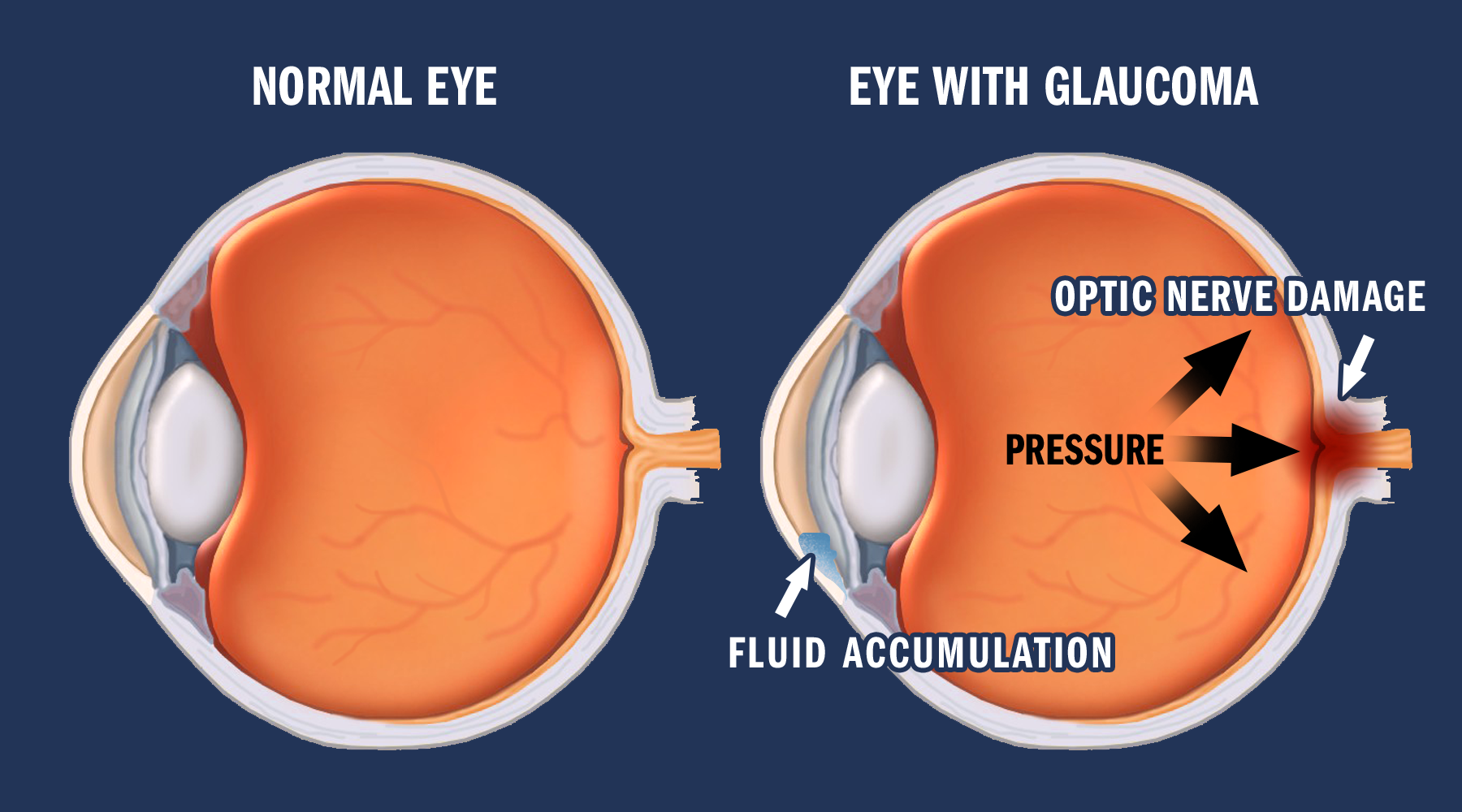 Eye With and Without Glaucoma