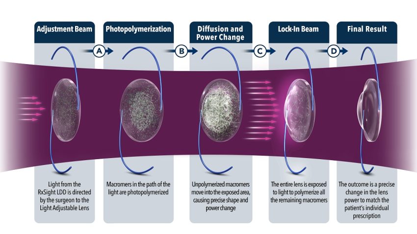 Light Adjustable Lens Mechanism of Action